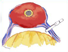 Neurovascular Bundle