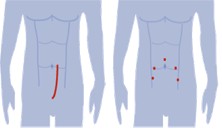 Robotic Prostatetomy | Laparoscopic Port Placement